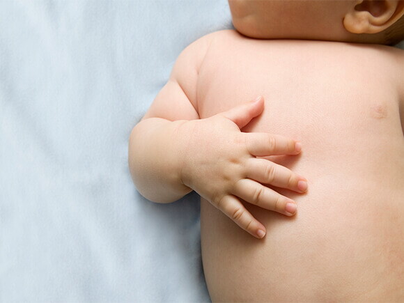 Dermatite atópica no bebé 
