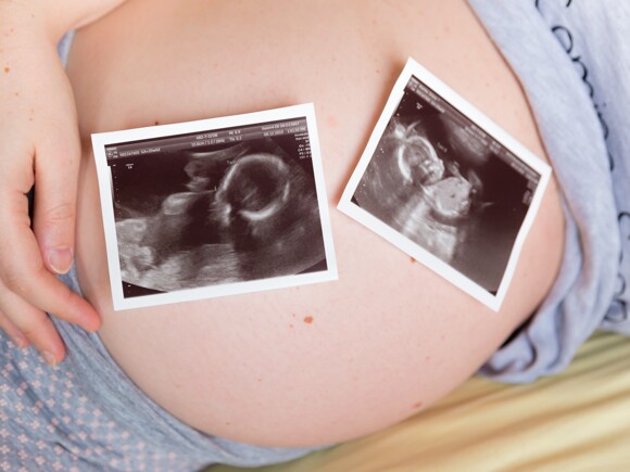 gravidez de gémeos