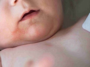 Impetigo: O Que É, Sintomas, Tratamento e Como Prevenir