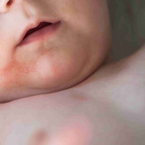 Impetigo: O Que É, Sintomas, Tratamento e Como Prevenir Impetigo: O Que É, Sintomas, Tratamento e Como Prevenir