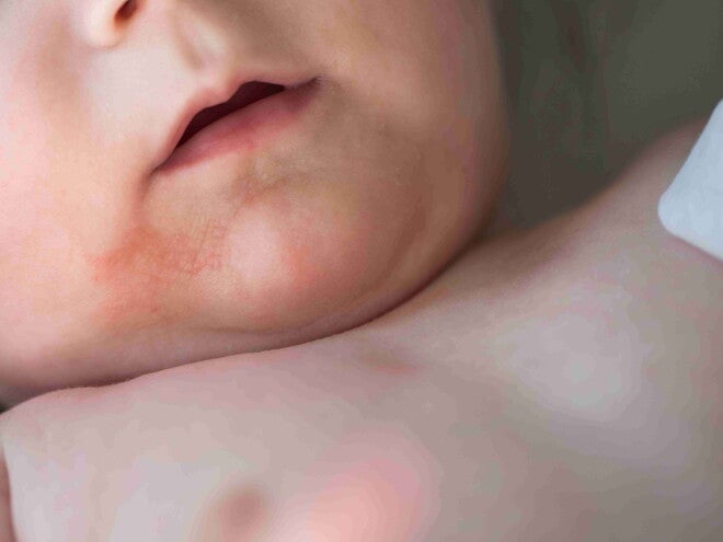Impetigo: O Que É, Sintomas, Tratamento e Como Prevenir Impetigo: O Que É, Sintomas, Tratamento e Como Prevenir